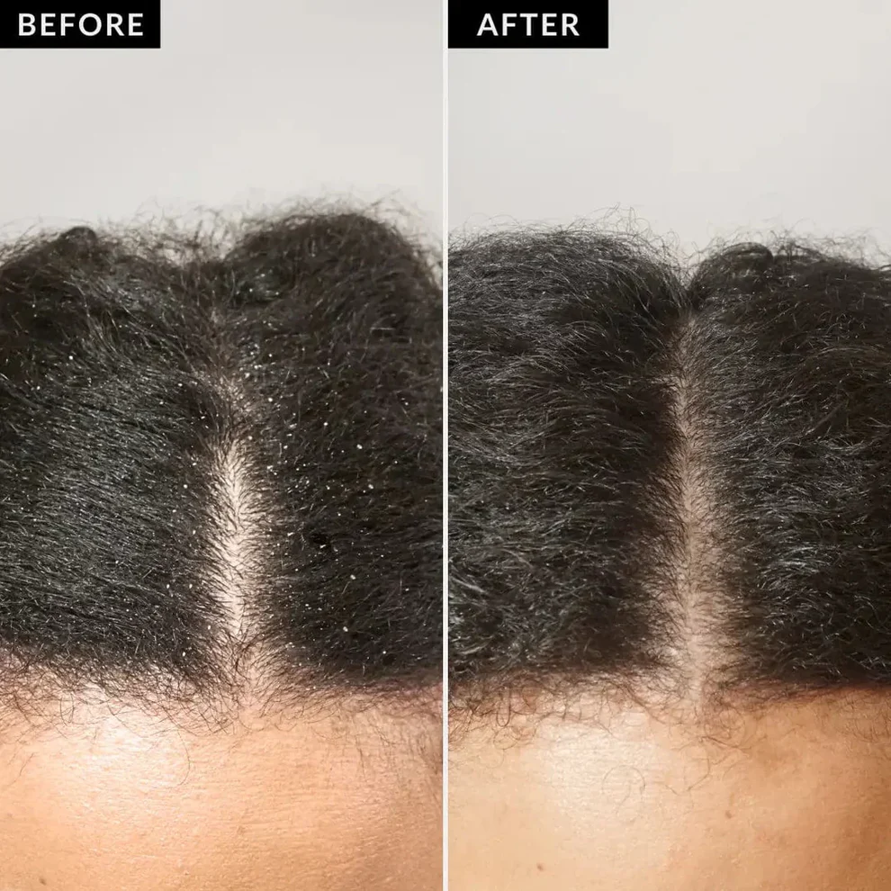 EXFOLICOMB™ – Scalp Detox Comb